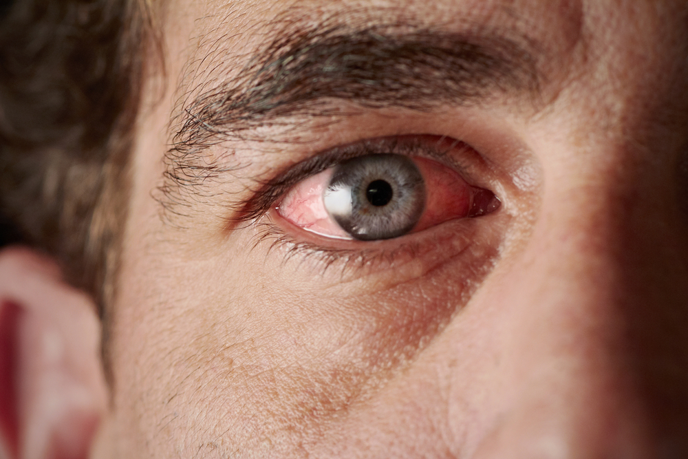 Pink Eye What You Should Know First Eye Care DFW Keller