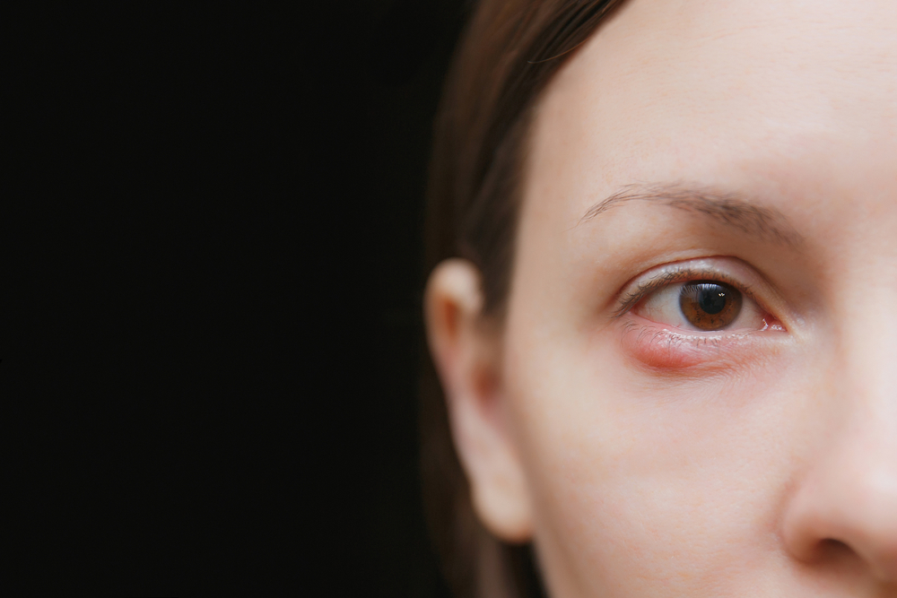 How to Get Rid of a Stye - First Eye Care DFW