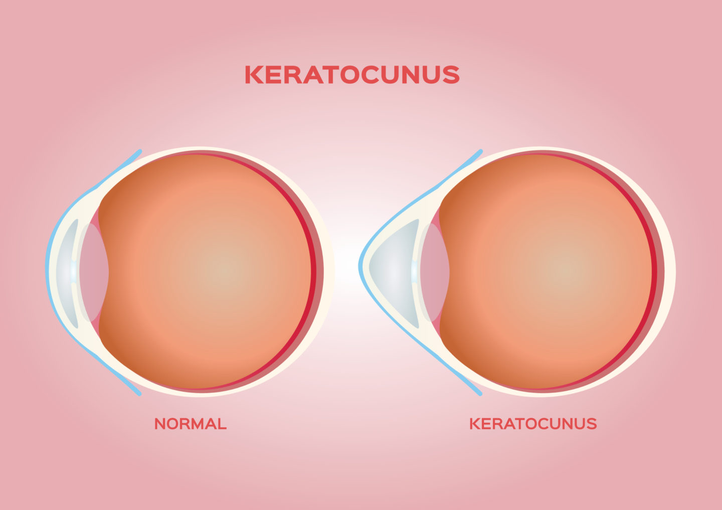 Keratoconus Treatment Options - First Eye Care DFW