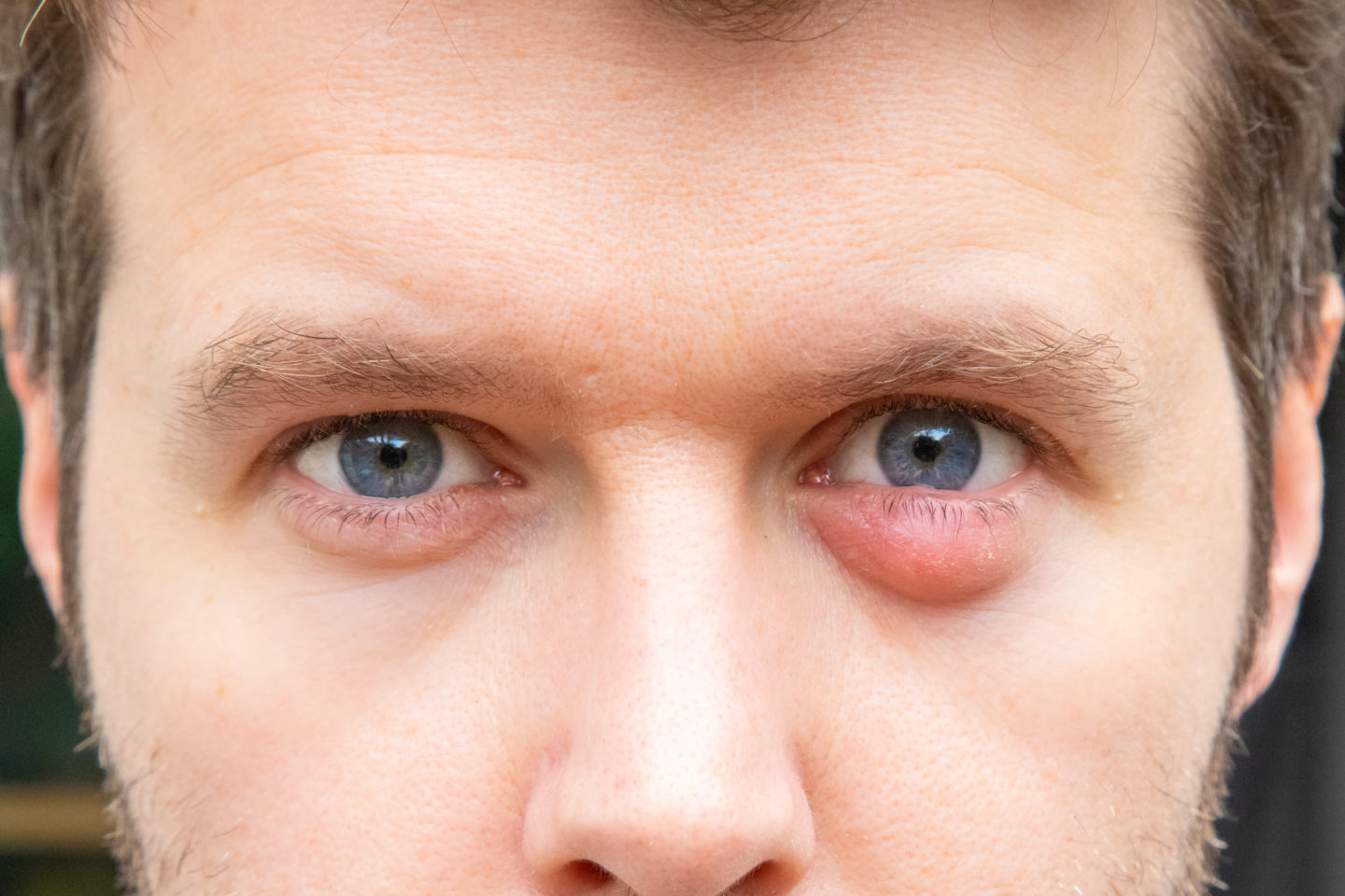 Stye vs. Chalazion - First Eye Care DFW